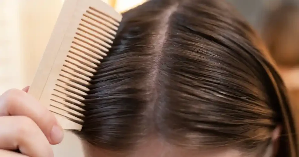 oily dandruff remedies